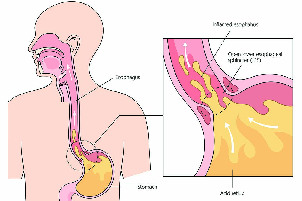درمان سوزش معده با تغییرات سبک زندگی